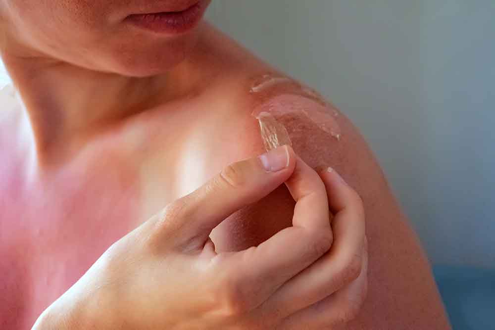Sunburn - Effects of Sunburn