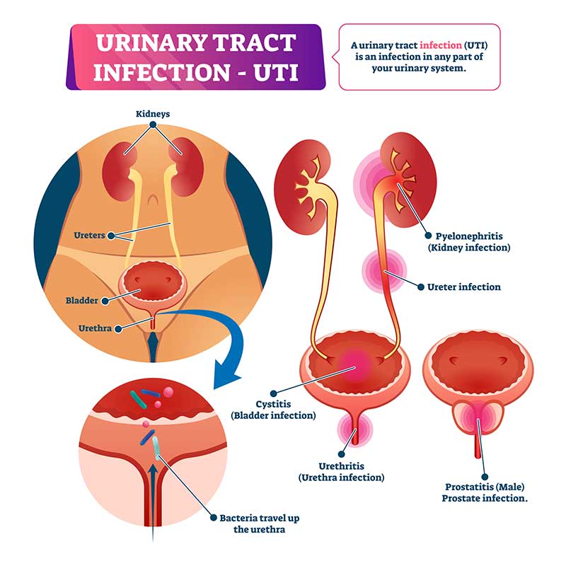 Urinary Tract Infection - UTI